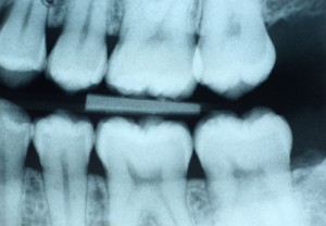 Dental X-Ray