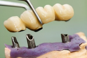 Bridges at Time for Smiles Dental Center